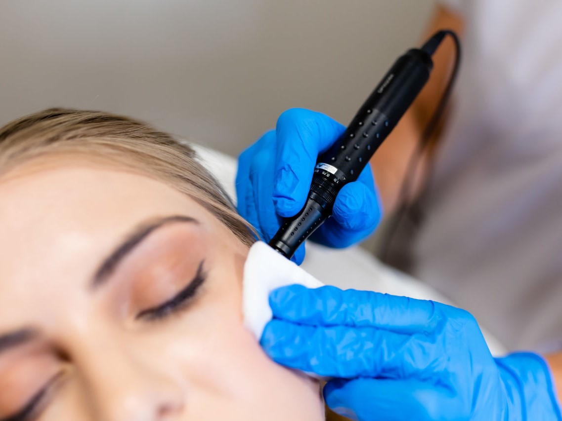 Dermapen at Frontalis Clinic